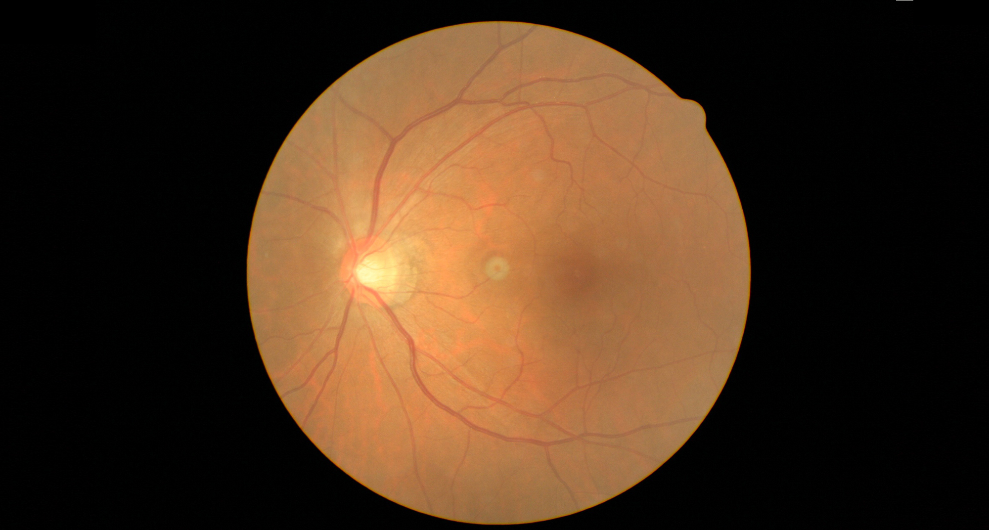 眼底検査・眼圧検査