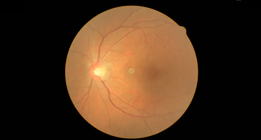 眼底検査・眼圧検査