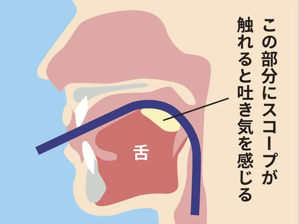 口からの胃カメラ検査